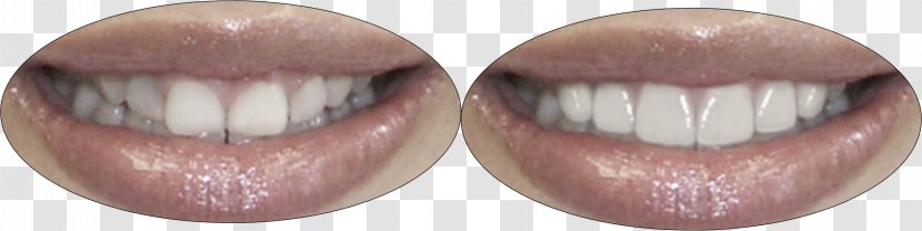 Crown Lengthening Veneer Dentistry Mouth - Flower Transparent PNG