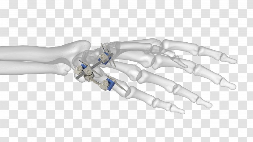 Thumb Ortho-aktiv Medizintechnik GmbH External Fixation Distal Radius Fracture Bone - Quality Transparent PNG