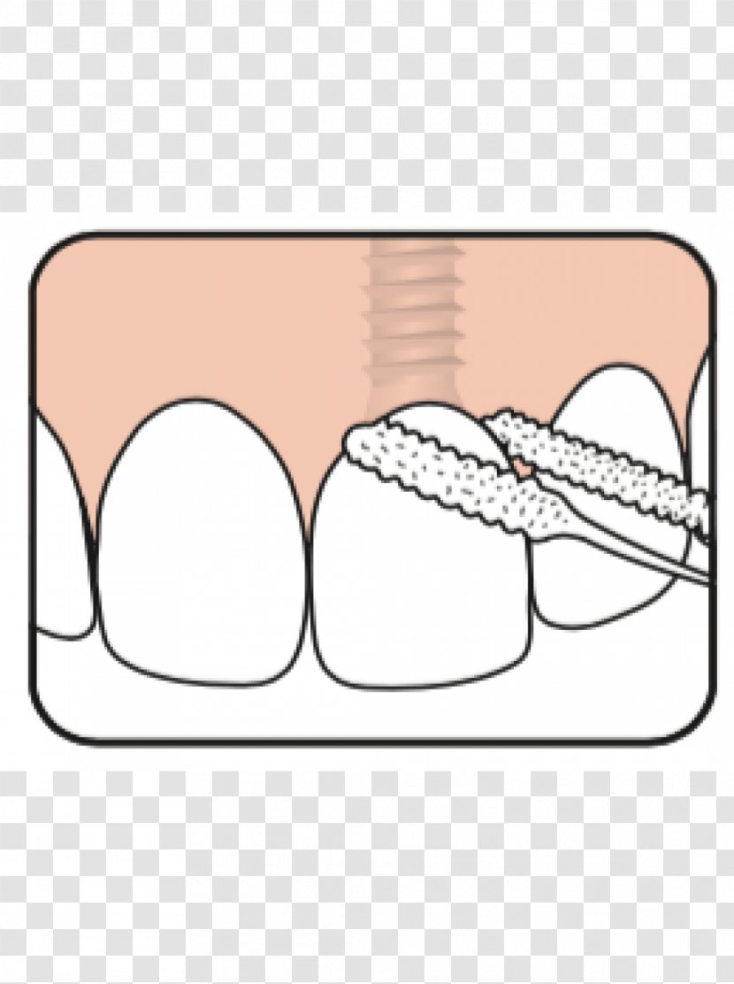 Dental Floss Nit Tooth Implant Jaw - Frame - Tree Transparent PNG