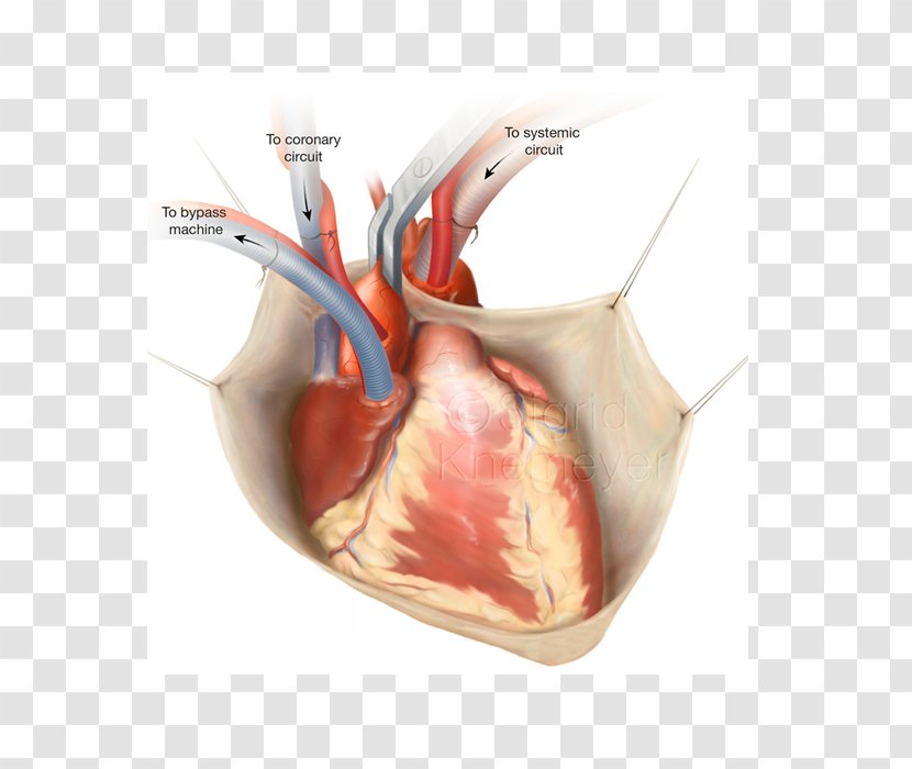 Coronary Artery Bypass Surgery Vascular Off-pump Disease - Watercolor - Heart Transparent PNG