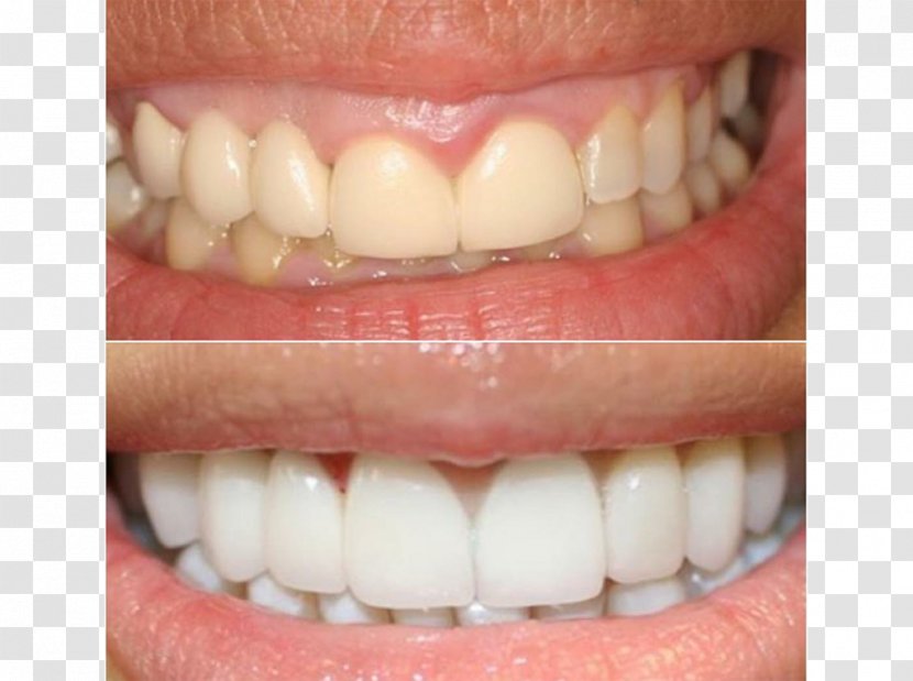 Tooth Whitening Veneer Dental Porcelain Human - Smile - Crown Transparent PNG