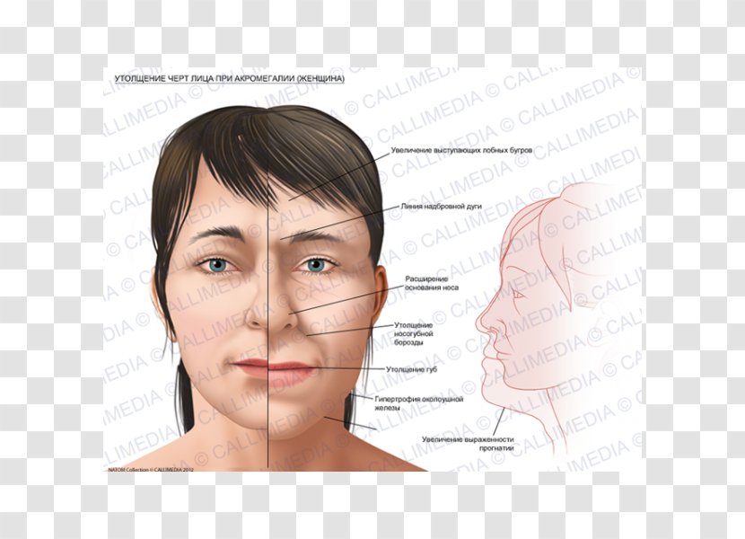 Acromegaly Gigantism Face Growth Hormone - Heart Transparent PNG