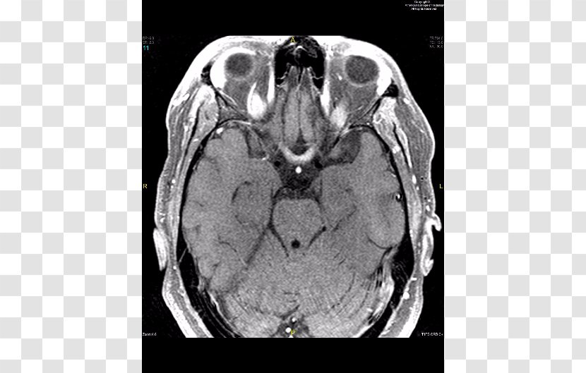 Neuromyelitis Optica Spinal Cord Magnetic Resonance Imaging Neurology White Matter - Tree - Brain Transparent PNG