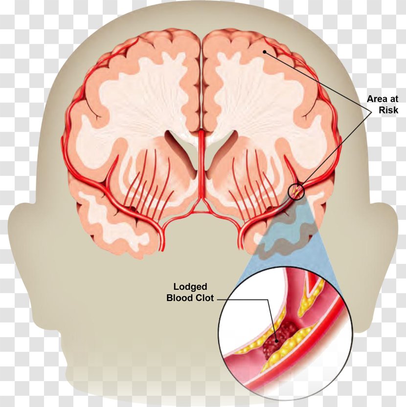 Stroke Transient Ischemic Attack Neurology Brain Haemorrhage Health - Cartoon Transparent PNG