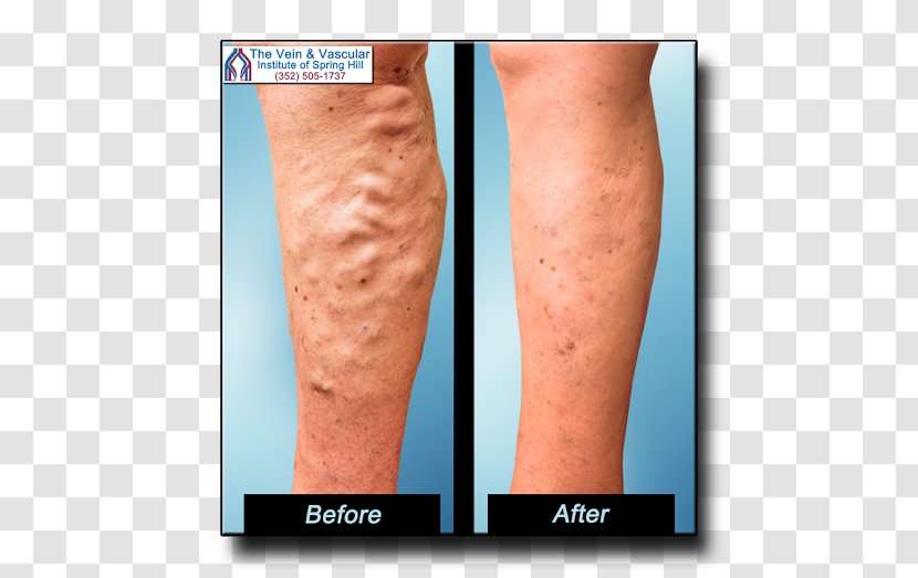 Varicose Veins Vascular Surgery The Vein And Institute Of Tampa Bay Telangiectasia - Flower - Tree Transparent PNG