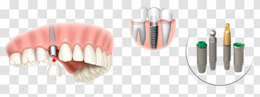 Dental Implant Dentistry Tooth Implantology - Crown Transparent PNG