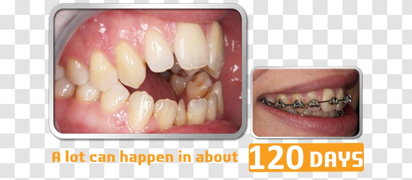 Tooth Dental Braces Orthodontics Dentistry - Jaw - Month Of Fasting Transparent PNG