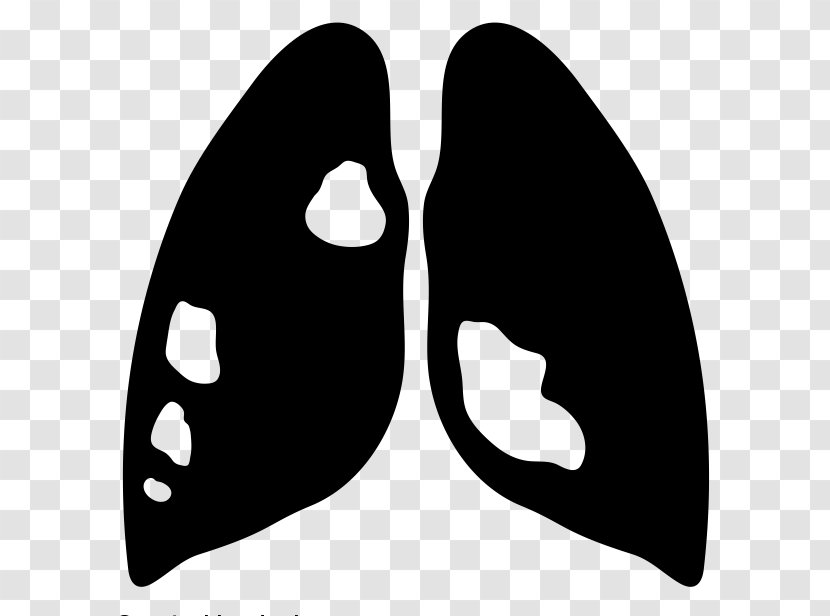 Lung Cancer Respiratory Disease - Lower Tract Infection Transparent PNG