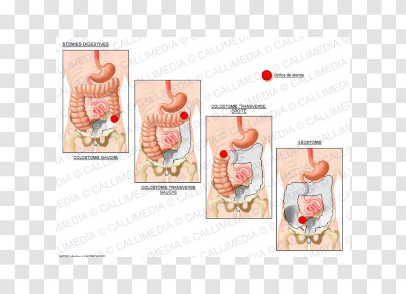 Stoma Ileostomy Ostomía Digestion Colostomy - Frame - Endocrine System Transparent PNG