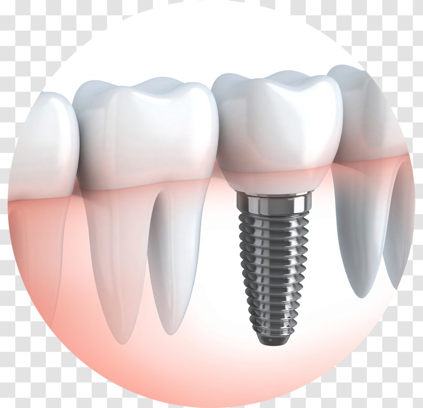 Dental Implant Dentistry Chapel Gate Crown - Tree Transparent PNG