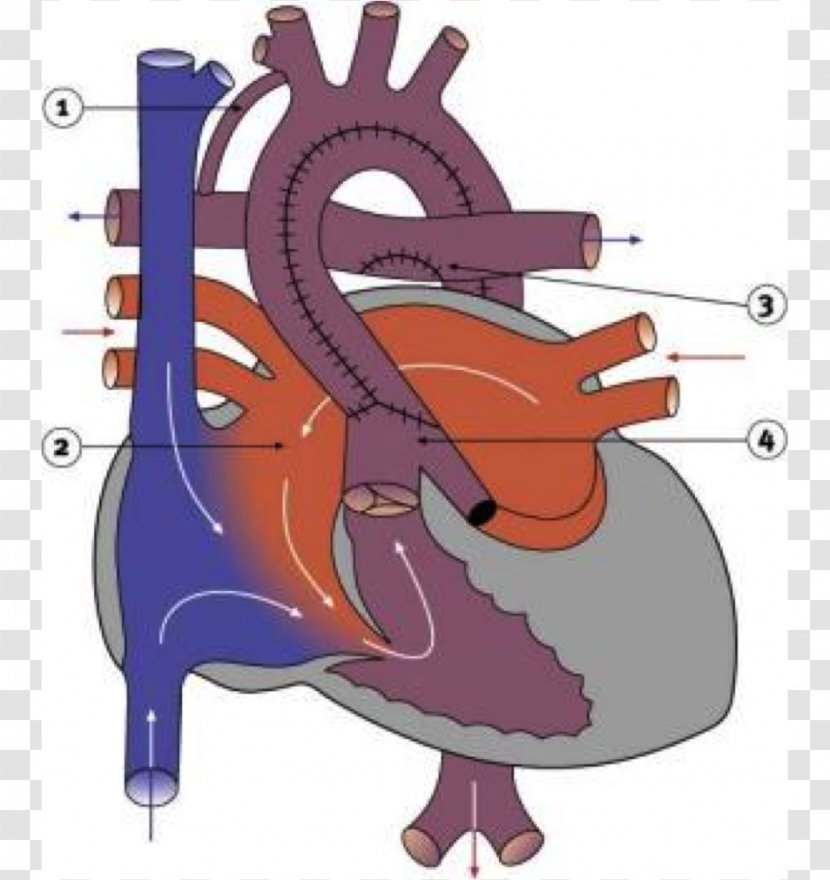 Coarctation Of The Aorta Ductus Arteriosus Congenital Heart Defect Ventricular Septal - Watercolor Transparent PNG
