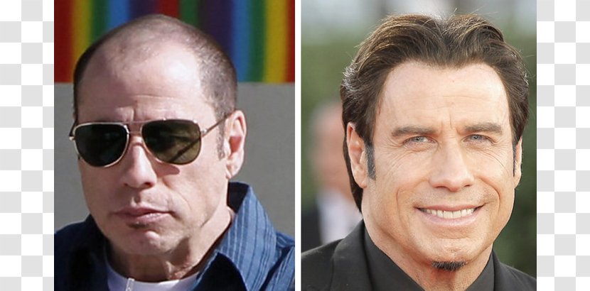 John Travolta Cleese Hair Transplantation Loss Celebrity - Actor Transparent PNG