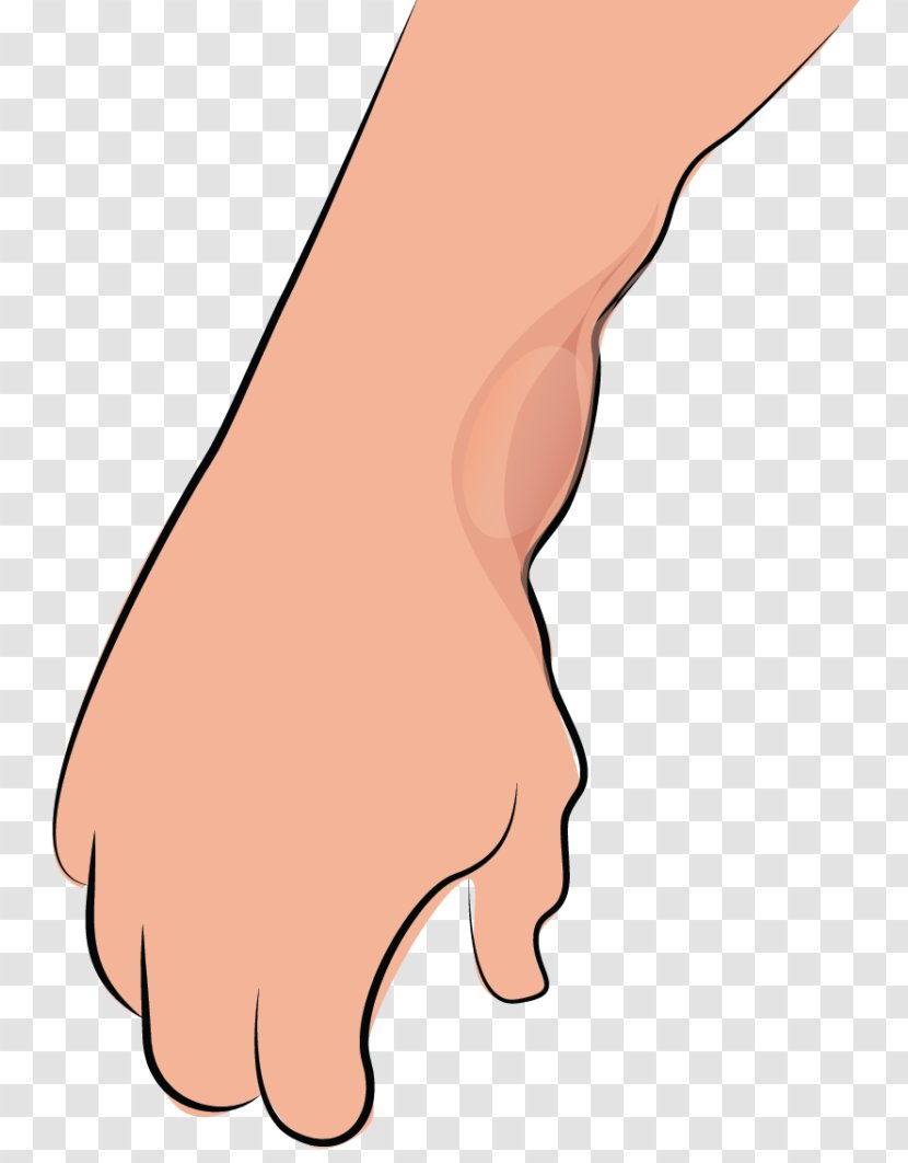 Thumb Synovial Cyst Surgery Tendon - Frame - Ganglion Transparent PNG