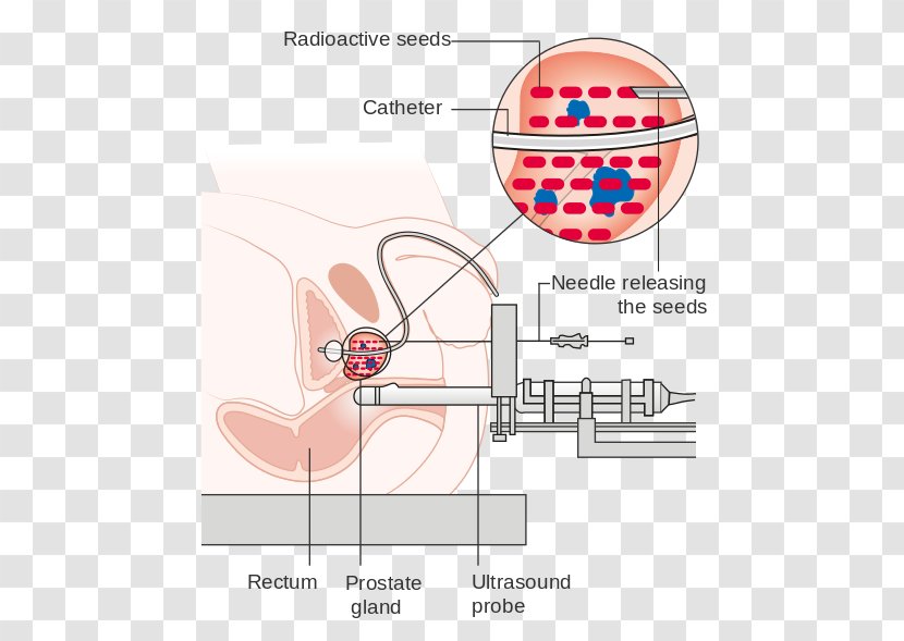 Radiation Therapy Prostate Cancer Brachytherapy Proton - Flower - Tree Transparent PNG