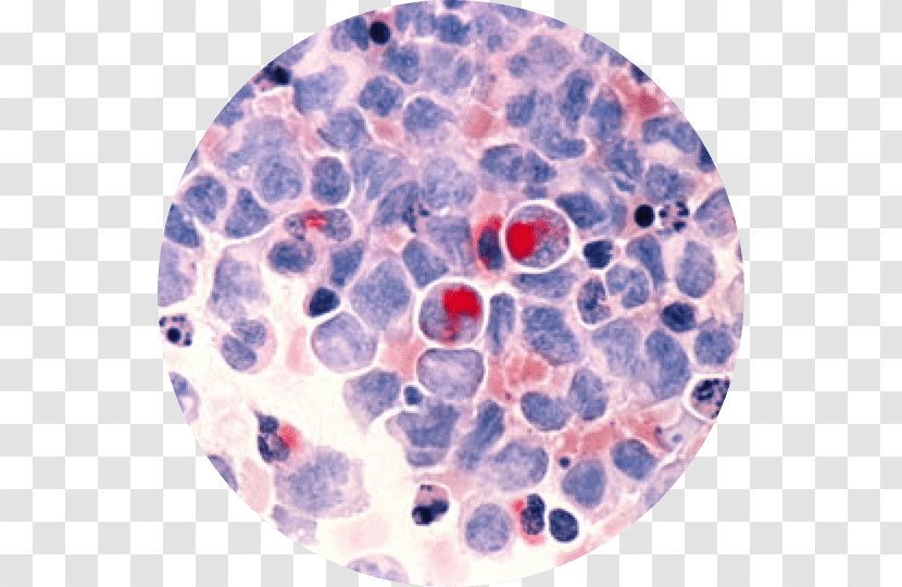 Acute Myeloid Leukemia Cancer Gemtuzumab Ozogamicin Lymphoblastic - Bone Marrow Transparent PNG