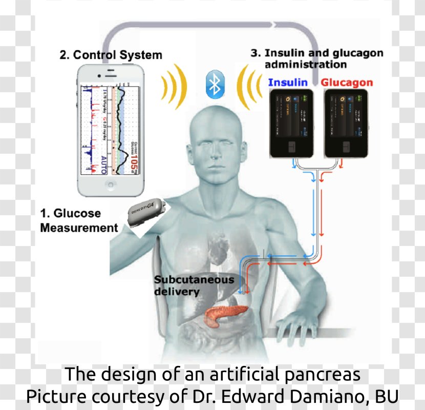 Artificial Pancreas Diabetes Mellitus Type 2 Blood Sugar Transparent PNG