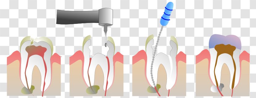 Endodontic Therapy Root Canal Pulp Endodontics Dentistry - Tooth - Nerve Transparent PNG