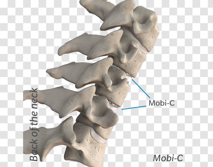 The Cervical Disc Surgery Anterior Discectomy And Fusion Vertebrae Intervertebral Arthroplasty - Organism - Neck Transparent PNG