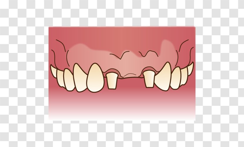 Tooth Dentures Dentist 歯科 Bridge - Silhouette Transparent PNG