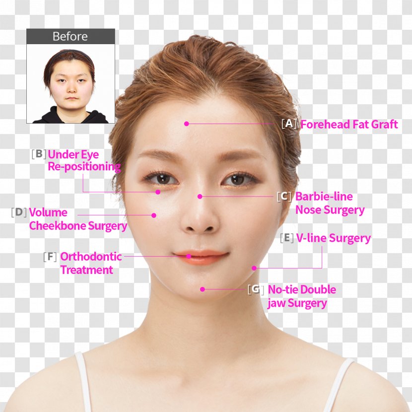 Kim Ji Hyun 美容外科学 South Korea Surgery Hospital - Forehead - Dental Chin Transparent PNG