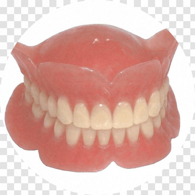 Dentures Dentistry Removable Partial Denture Dental Implant - Bridge Transparent PNG