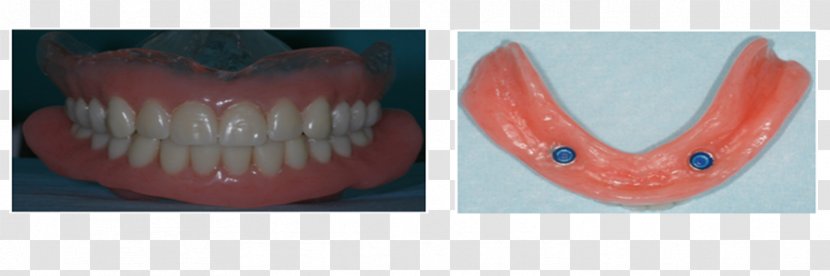 Tooth Dentures - Lip - Dental Surgery Transparent PNG