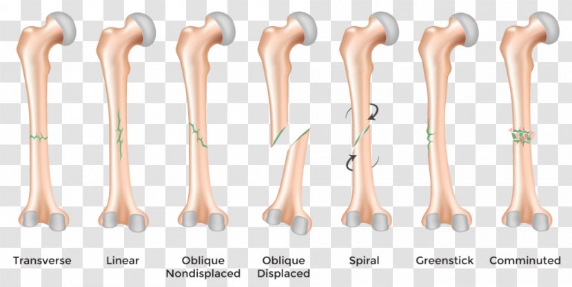 Bone Fracture Healing Greenstick Injury - Ankle - Bones Transparent PNG