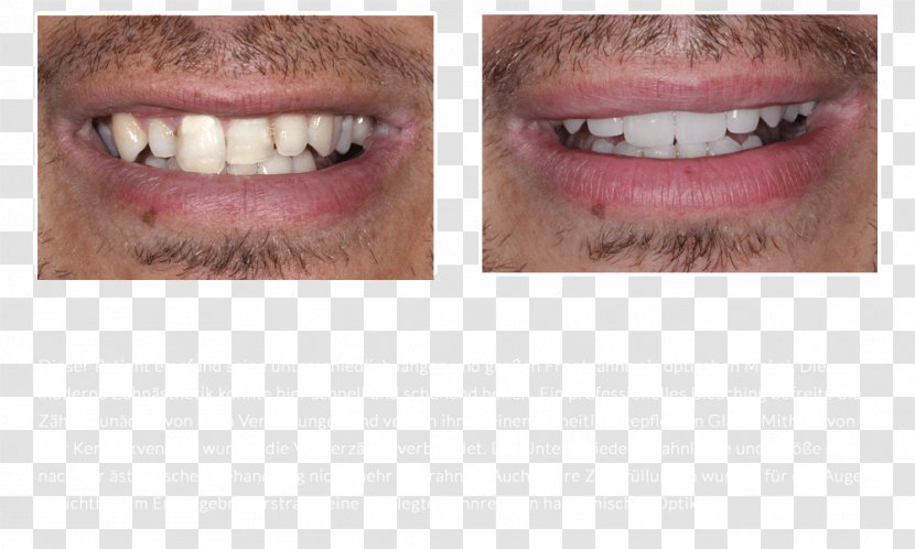 Tooth Whitening Veneer DiPura Bridge - Cosmetic Dentistry Transparent PNG