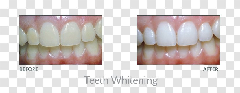 Tooth Whitening Dentistry Human - Beauty - White Transparent PNG