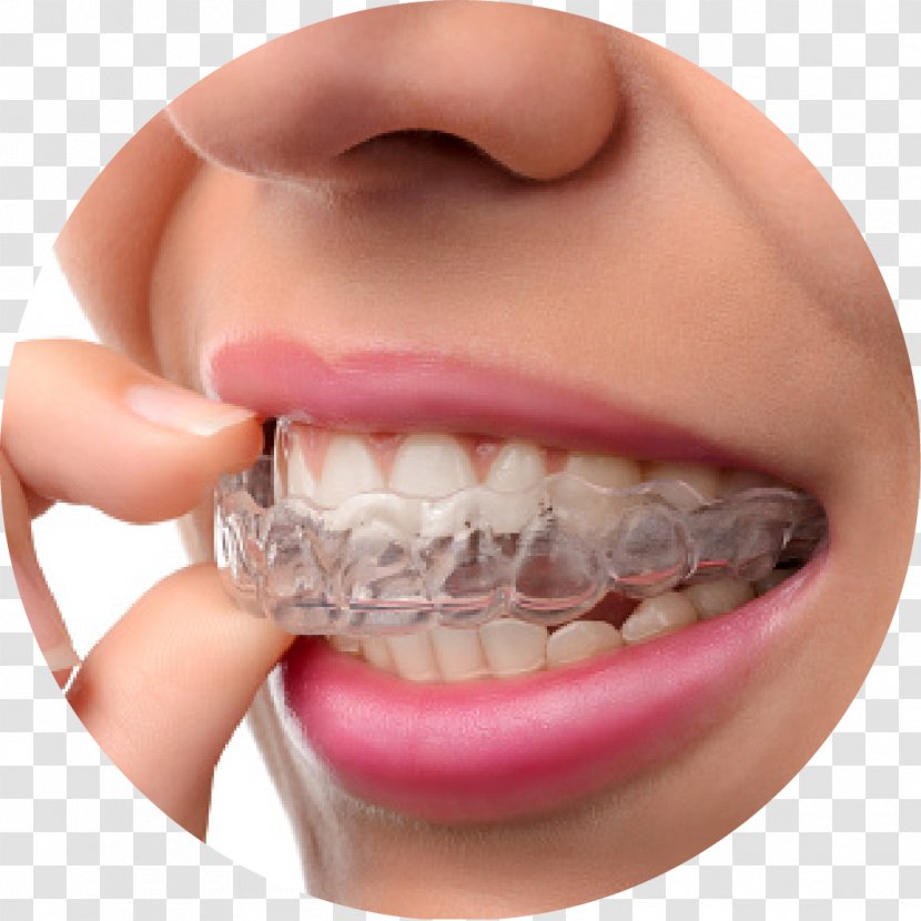 Dental Braces Clear Aligners Orthodontics Cosmetic Dentistry - Malocclusion - Crown Transparent PNG