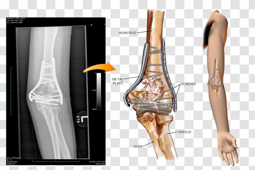 Screw Nail Nut Steel Bone - Surgery Transparent PNG