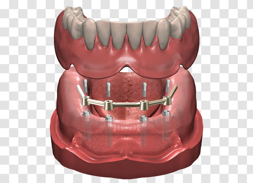 Dentures Dental Implant Prosthesis Dentist - Cartoon Transparent PNG