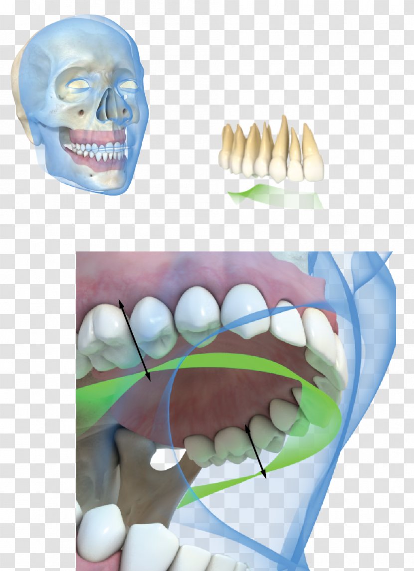 Tooth Dental Implant Occlusion Gums - Tree - Strips Board Transparent PNG