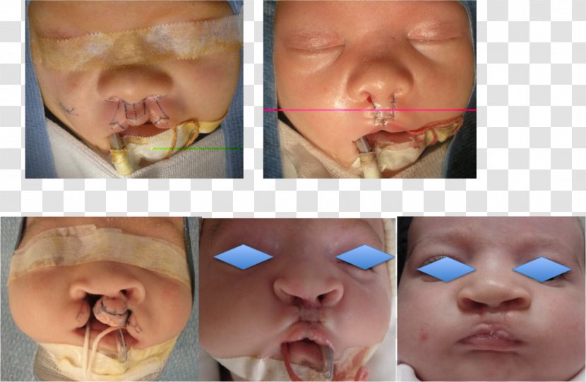 Cleft Lip And Palate Snout Infant Surgery - Neck - Emme Anthony Transparent PNG
