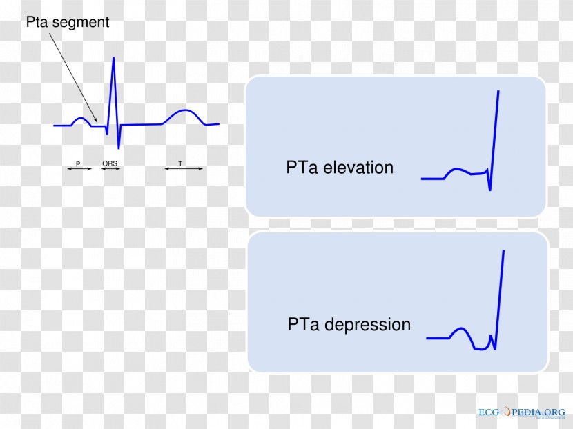 P Wave Electrocardiogram Electrocardiography QRS Complex Sinus Rhythm - Hyperkalemia - Pericarditis Transparent PNG