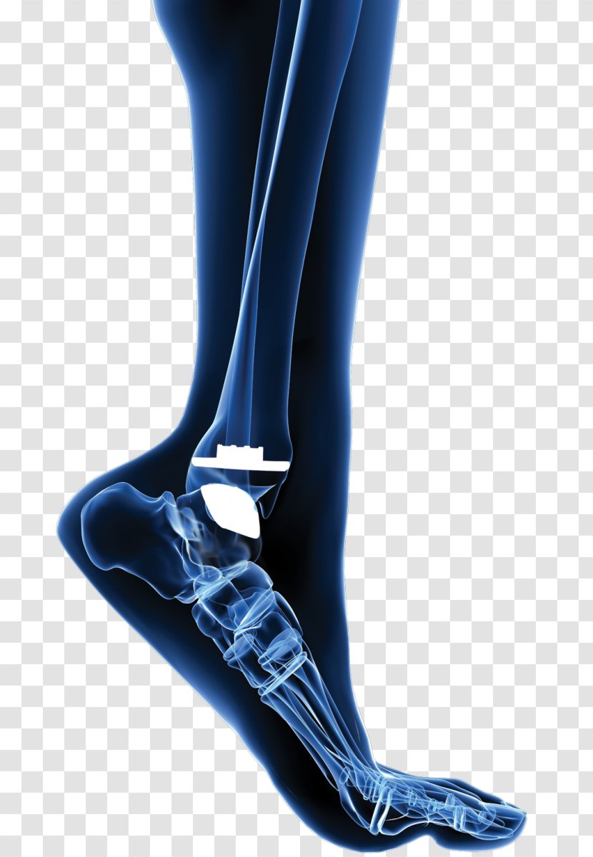 Total Ankle Arthroplasty Replacement Joint - Frame Transparent PNG