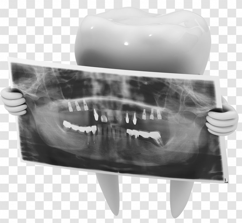 Dental Radiography X-ray Dentistry Tooth - Implant - Film Transparent PNG