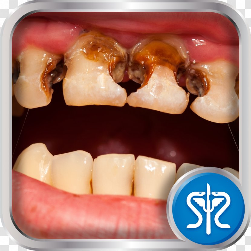 Tooth Decay Toothache Dentistry Medicine - Alternative Health Services Transparent PNG