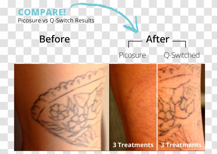 Tattoo Removal Détatouage Laser Q-switching - Lowerback Transparent PNG