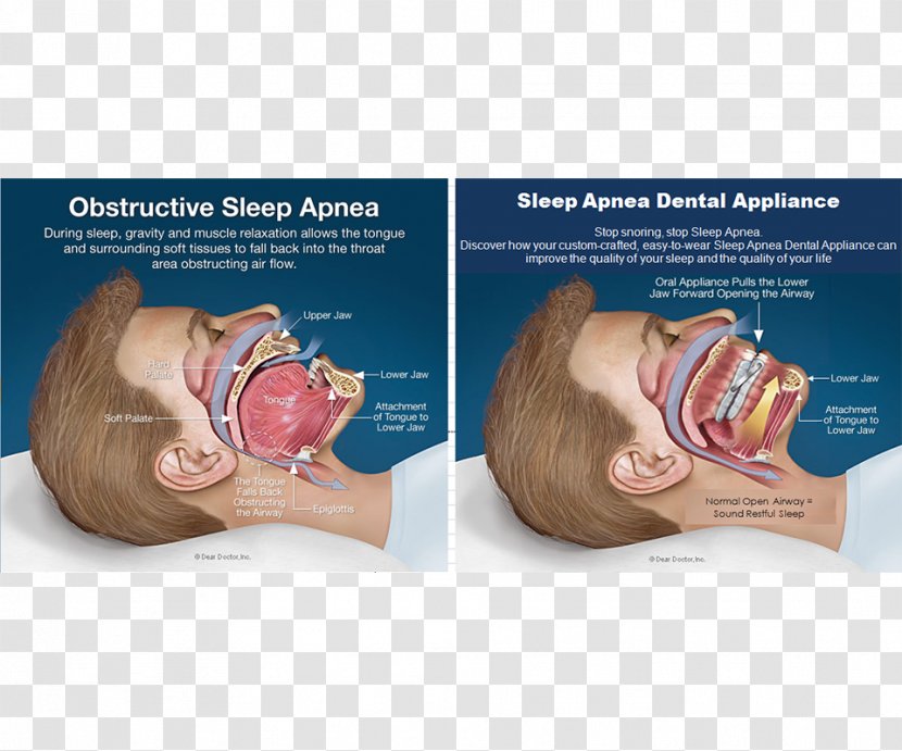Obstructive Sleep Apnea Continuous Positive Airway Pressure - Medicine - Snoring Transparent PNG