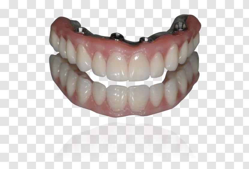 Tooth All-on-4 Dental Implant Dentures - Implants Transparent PNG