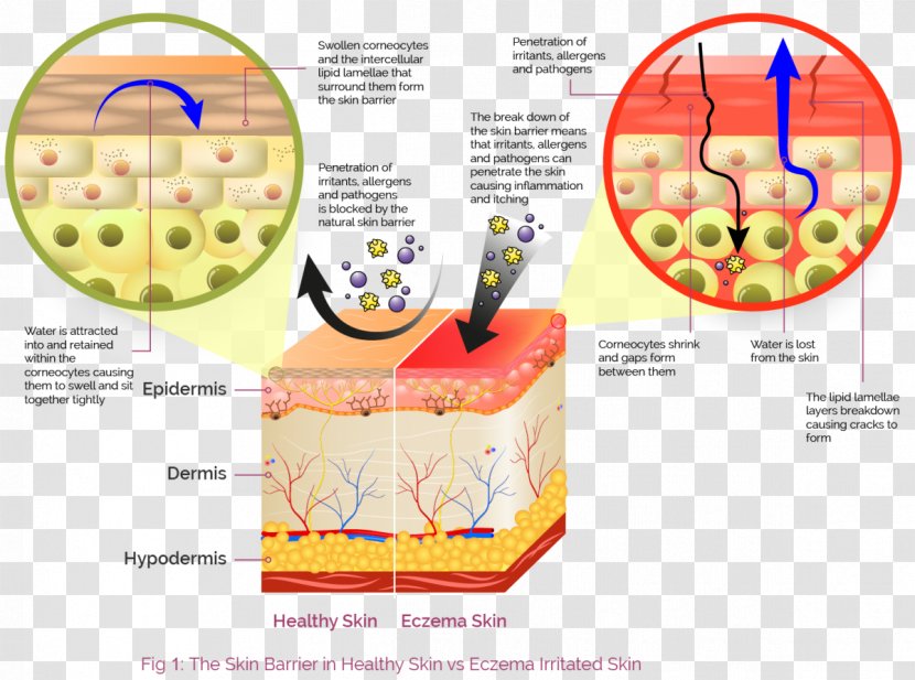 Contact Dermatitis Skin Seborrheic Cutaneous Condition - Cartoon Pathogen Transparent PNG