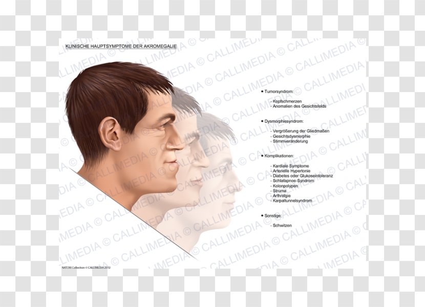 Nose Acromegaly Symptom Pituitary Gland Medical Sign - Body Transparent PNG
