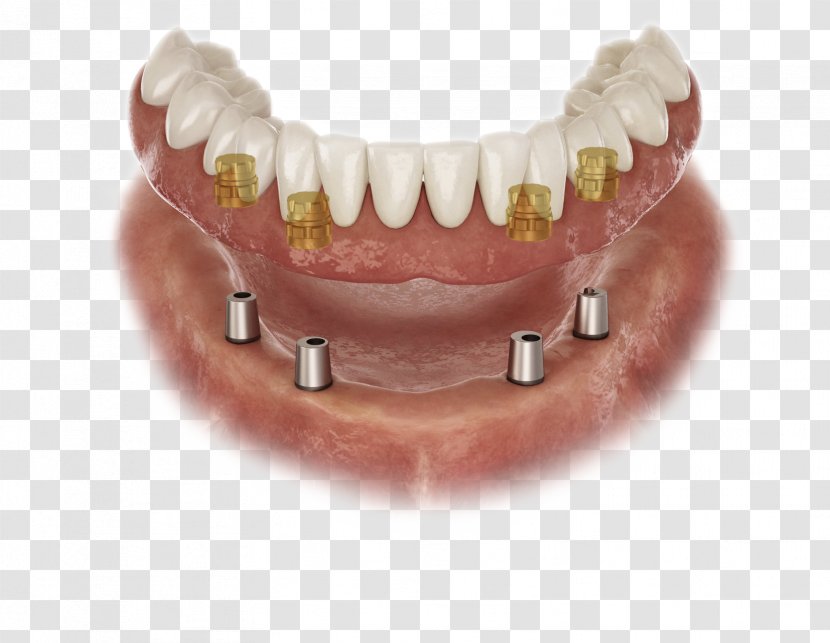 Abutment Dental Implant Prosthesis Laboratory Dentures - Dentistry - Crown Transparent PNG