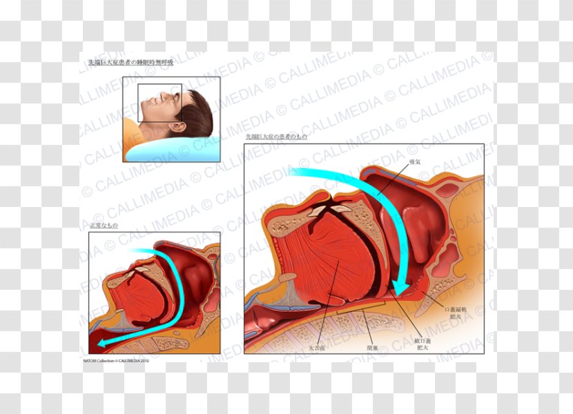 Acromegaly Endocrinology Diabetes Mellitus Diabetology Endocrine System - Watercolor - Acromegalia Transparent PNG