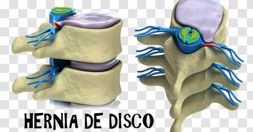 Spinal Disc Herniation Vertebral Column Lumbar Vertebrae Intervertebral Therapy - Cord Injury - Organism Transparent PNG
