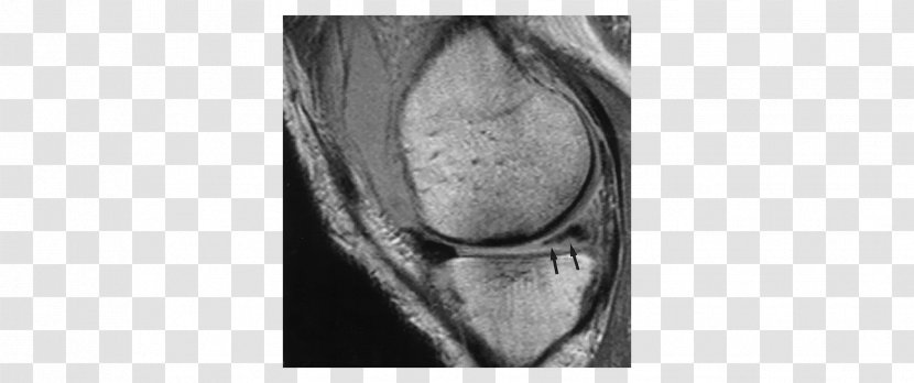 Knee Meniscus Magnetic Resonance Imaging Ligament X-ray - Frame - Mri Transparent PNG