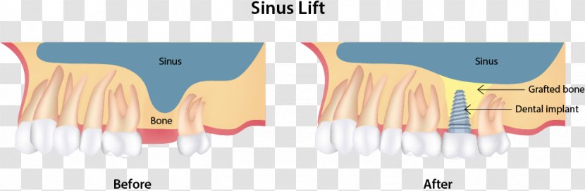 Sinus Lift Dental Implant Dentist Surgery - Flower Transparent PNG
