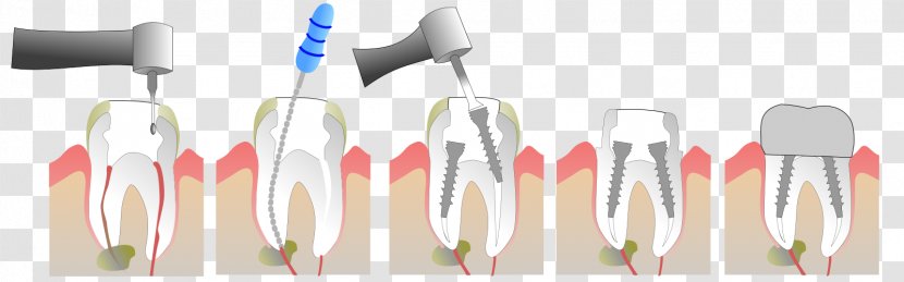 Root Canal Endodontic Therapy Crown Tooth Dentist - Bridge - Une Dent Transparent PNG