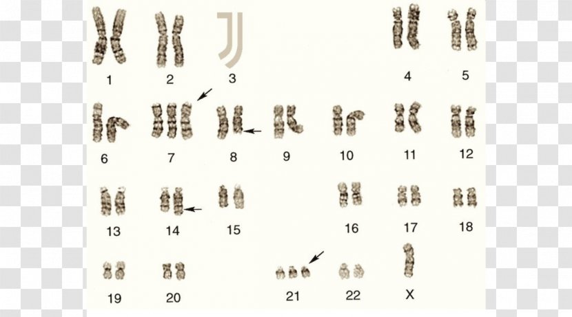 Trisomy Karyotype Nondisjunction Chromosome 21 Amyotrophic Lateral Sclerosis - Watercolor - Dani Alves Transparent PNG